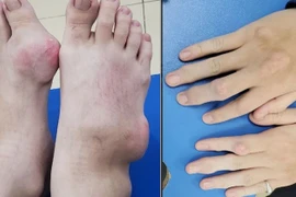 Nam thanh niên biến dạng tay chân nặng do biến chứng của bệnh gout