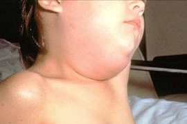 Nhận biết sớm dấu hiệu bệnh quai bị ở trẻ em giúp hạn chế biến chứng