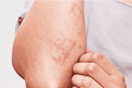 Số ca nhiễm giun đũa chó mèo tại Khánh Hòa tăng cao trong hơn 1 tháng qua