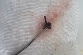 Con vắt dài 3cm ký sinh trong mũi cô gái 21 tuổi 