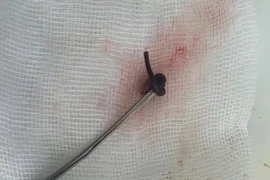 Con vắt dài 3cm ký sinh trong mũi cô gái 21 tuổi 