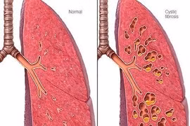 Châu Âu cấp phép thuốc điều trị giãn phế quản không do xơ nang