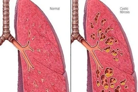 Châu Âu cấp phép thuốc điều trị giãn phế quản không do xơ nang