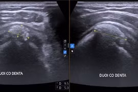 Đau vai cả tháng, người phụ nữ phát hiện viêm gân vôi hóa