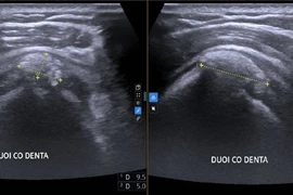 Đau vai cả tháng, người phụ nữ phát hiện viêm gân vôi hóa