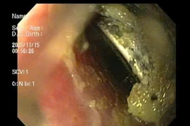 Cứu bé trai gần 3 tuổi nuốt pin cúc áo loét thực quản