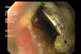 Cứu bé trai gần 3 tuổi nuốt pin cúc áo loét thực quản