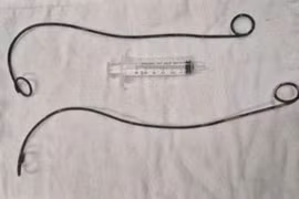 Phẫu thuật lấy 2 ống thông JJ bị bệnh nhân 'bỏ quên' trong người hơn 10 năm