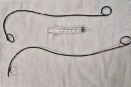 Phẫu thuật lấy 2 ống thông JJ bị bệnh nhân 'bỏ quên' trong người hơn 10 năm