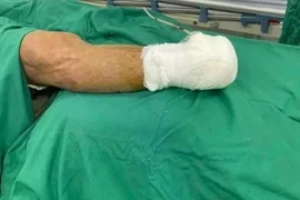 Cụ ông phải cắt cụt chi dưới vì xơ vữa động mạch gây tắc, hoại tử