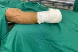 Cụ ông phải cắt cụt chi dưới vì xơ vữa động mạch gây tắc, hoại tử