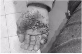 Trẻ 13 tuổi bị bỏng nặng do điện thoại phát nổ khi sạc