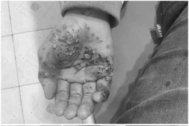 Trẻ 13 tuổi bị bỏng nặng do điện thoại phát nổ khi sạc