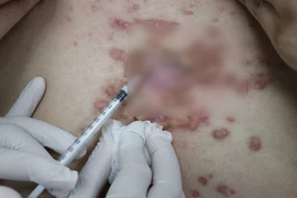 Bị áp xe nghiêm trọng khi tiêm chất làm đầy kém chất lượng
