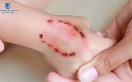 Bé 8 tuổi suy hô hấp, tổn thương não sau 5 tháng bị chó cắn