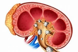 Phẫu thuật sỏi san hô phức tạp thành công cho bệnh nhân suy thận