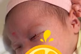 Bé gái 18 ngày tuổi mắc viêm kết mạc sơ sinh nặng