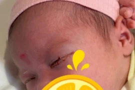Bé gái 18 ngày tuổi mắc viêm kết mạc sơ sinh nặng