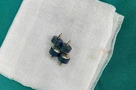 Bệnh nhi 2 tuổi ở Nghệ An nuốt 4 viên đinh nam châm đầu nhọn nguy hiểm