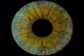 Ca ghép giác mạc in 3D đầu tiên trên người, giúp bệnh nhân mù lấy lại thị lực