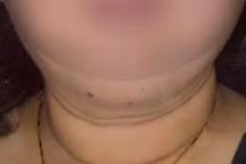 Cơ thể người phụ nữ “biến dạng” do lạm dụng thuốc corticoid