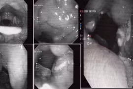 Viêm amidan cấp mủ có thể gây nhiều biến chứng nguy hiểm 