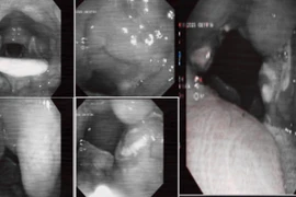 Viêm amidan cấp mủ có thể gây nhiều biến chứng nguy hiểm 