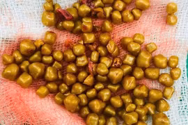 Gắp hơn 100 viên sỏi từ túi mật của nữ bệnh nhân 54 tuổi