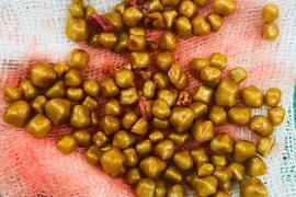 Gắp hơn 100 viên sỏi từ túi mật của nữ bệnh nhân 54 tuổi