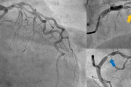 Người phụ nữ 77 tuổi, đột ngột mệt, thở ngáp rồi ngừng tim, hôn mê