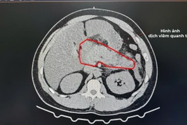 Bệnh nhân nam 28 tuổi bị viêm tụy cấp nặng do tăng triglycerid máu