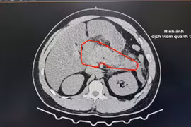 Bệnh nhân nam 28 tuổi bị viêm tụy cấp nặng do tăng triglycerid máu