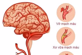 Báo động đột quỵ não gia tăng nhanh ở người trẻ tuổi