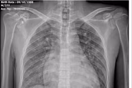 Cứu thành công ca tăng kali máu nguy kịch ở Nghệ An