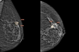 Cụ bà 75 tuổi bất ngờ khi phát hiện ung thư vú giai đoạn xâm nhập