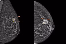 Cụ bà 75 tuổi bất ngờ khi phát hiện ung thư vú giai đoạn xâm nhập