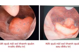 Người phụ nữ phù nề thanh quản do ngậm vitamin C sủi trị hóc xương cá