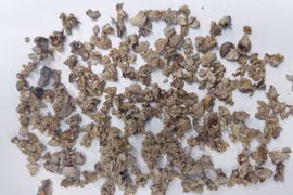 Phẫu thuật thành công ca sỏi thận san hô phức tạp cho người phụ nữ ở Nghệ An