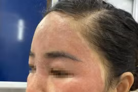 'Làm đẹp cấp tốc' đón Tết, người phụ nữ hỏng khuôn mặt