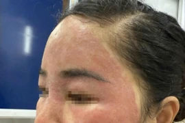 'Làm đẹp cấp tốc' đón Tết, người phụ nữ hỏng khuôn mặt