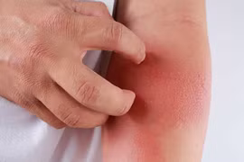 Số trẻ đến khám vì ban nhiễm trùng tăng cao