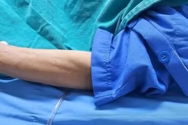 Bệnh nhân 71 tuổi ở Ninh Bình bị ong vò vẽ đốt biến chứng suy đa tạng