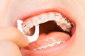 Người phụ nữ biến chứng nghiêm trọng sau 2 năm niềng răng