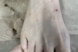 Người phụ nữ phải nhập viện do bôi nước chanh lên vết thương mèo cắn 