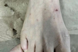 Người phụ nữ phải nhập viện do bôi nước chanh lên vết thương mèo cắn 