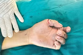 Nghịch dao cắt cỏ, bé trai ở Tây Ninh suýt mất 2 ngón tay