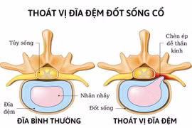 Thay nhân đĩa đệm nhân tạo giúp nam thanh niên thoát nguy cơ liệt tứ chi