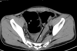 Người mắc hội chứng Pica thích ăn các đồ vật không phải thức ăn