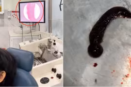 Kinh hãi con đỉa sống bên trong mũi người phụ nữ suốt 3 tuần