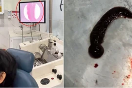 Kinh hãi con đỉa sống bên trong mũi người phụ nữ suốt 3 tuần